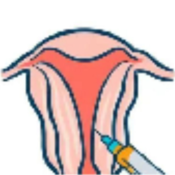 薄型子宫内膜修复